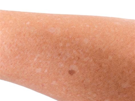 What Are Those White Spots On Your Skin From The Sun