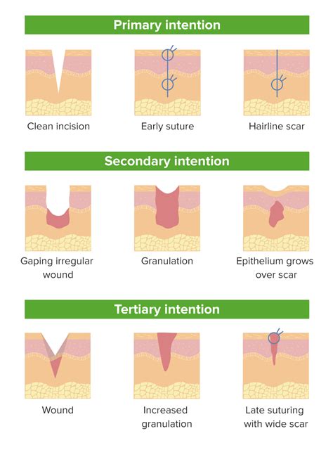 Phases Of Wound Healing