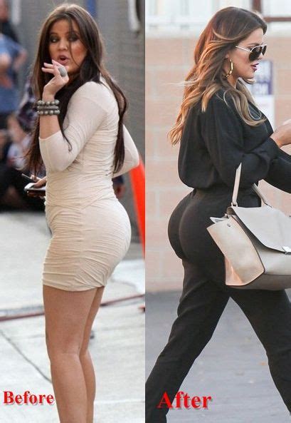Khole Kardashian Butt Implants Surgery Before And After Botox Butt