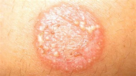 What To Do If Infected With Ringworm Thinking About Health
