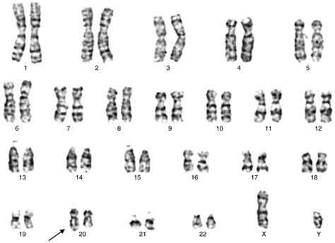 Turner Syndrome Male Karyotype
