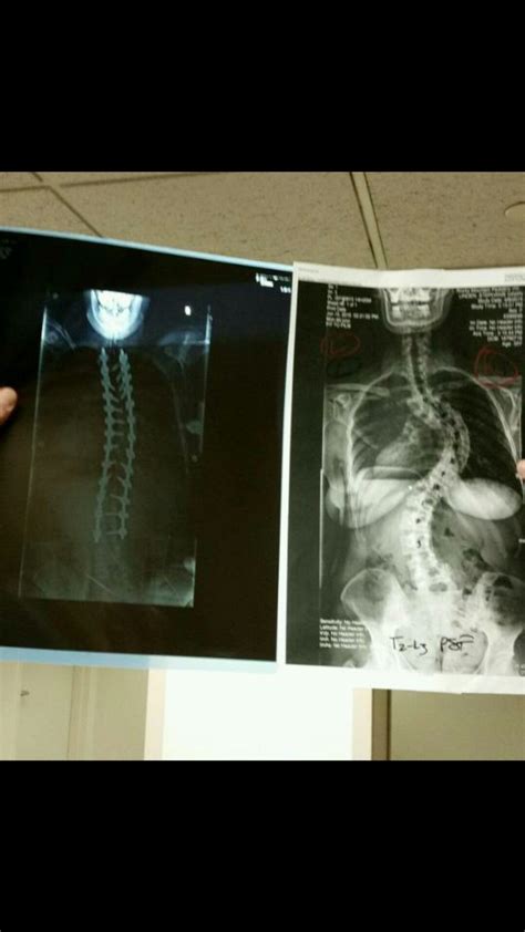 Scoliosis surgery before and after | Scoliosis surgery, Scoliosis, Surgery