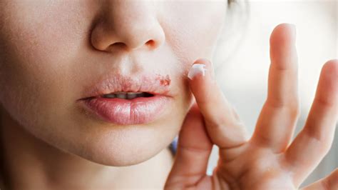Cold Sore Vs Pimple Key Differences Treatment And Prevention Pinkvilla