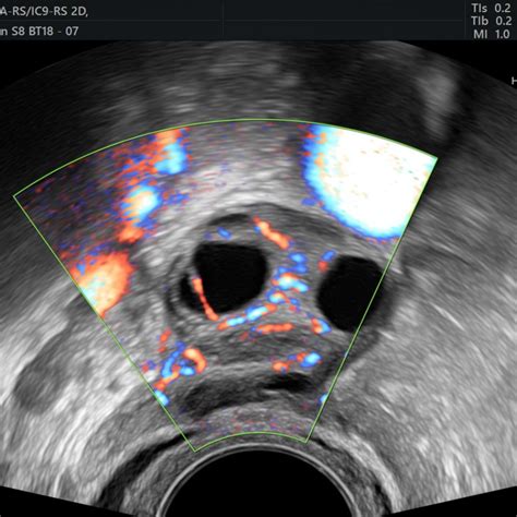 Gynaecological Pelvic Scan Private One On One Pregnancy And Fertility