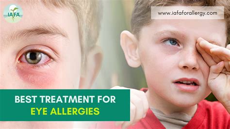 What Is The Best Treatment For Eye Allergies
