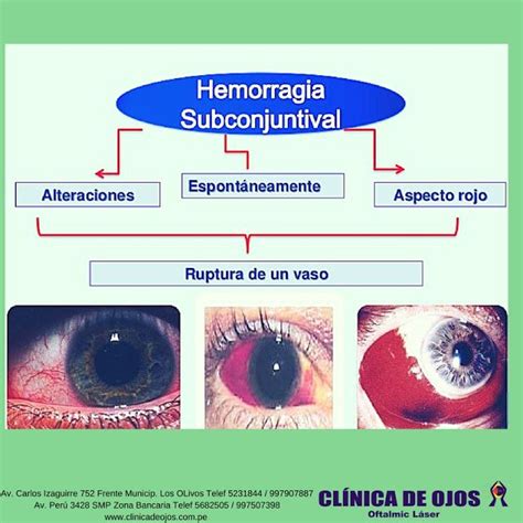 Clínica de Ojos Oftalmic Láser HEMORRAGIA SUBCONJUNTIVAL Hemorragia