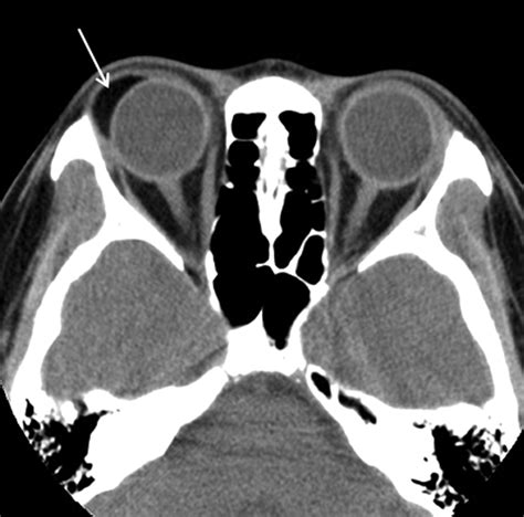 Orbital Septum Ct Scan Ct Scan Machine