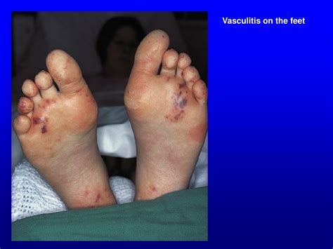 Vasculitis Rash Feet