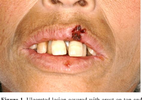 Figure From Oral Ulcers Induced By Cytomegalovirus Infection Report