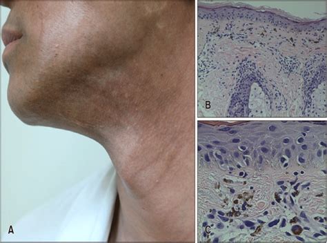 A Brown To Gray Hyperpigmentation On The Face And Neck B Vacuolar