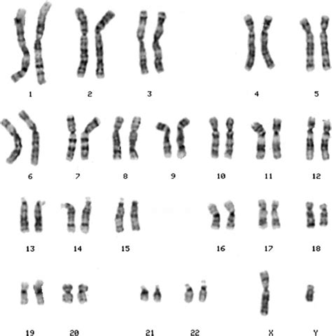 Chromosomes And Chromosomal Abnormalities Neupsy Key