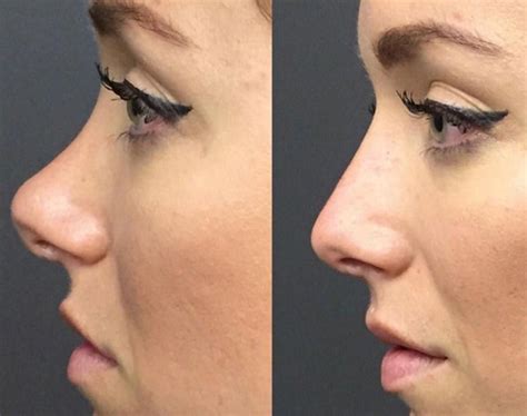 Why Nose Surgery Is The Most Complicated Cosmetic Procedure
