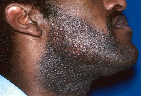 Rosacea Acne Shingles Covid 19 Rashes Common Adult Skin Diseases