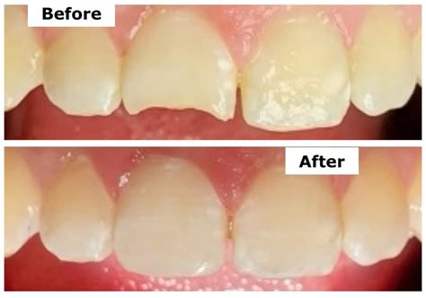 Fixing A Chipped Tooth Beffa Dental