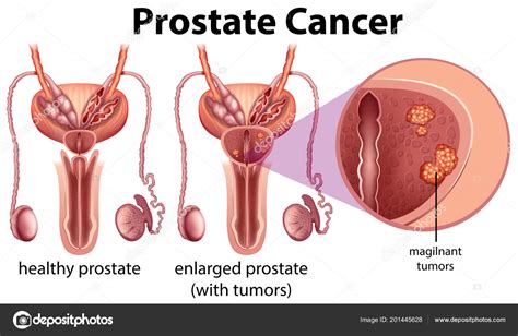 Cancer Prostate Sur Fond Blanc Illustration Stock Vector By Blueringmedia