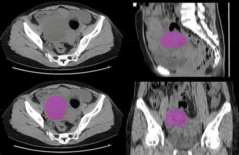 Frontiers Preoperative Prediction Of Metastasis For Ovarian Cancer