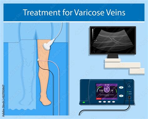 Vetor De Endovenous Laser Treatment Cvd Treat Elt Legs Inject Evlt