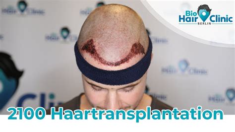 Haartransplantation Istanbul Endlich Wieder Haare Youtube
