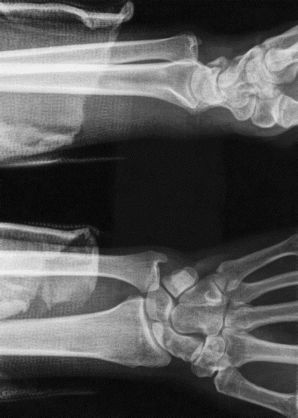 Distal Radioulnar Joint Dislocation In Association With Elbow Injuries