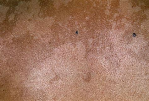 Pityriasis Versicolor Picture Image On