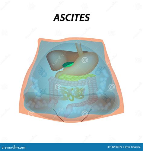 Ascites Free Fluid In The Abdominal Cavity Infographics Vector