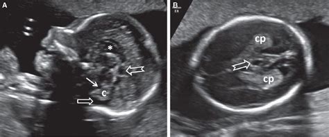 Normal Fetal Brain Ultrasound Anatomy