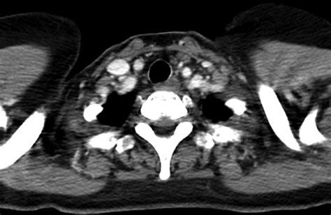 Supraclavicular Lymph Nodes Detected By 18f Fdg Petct In Cancer
