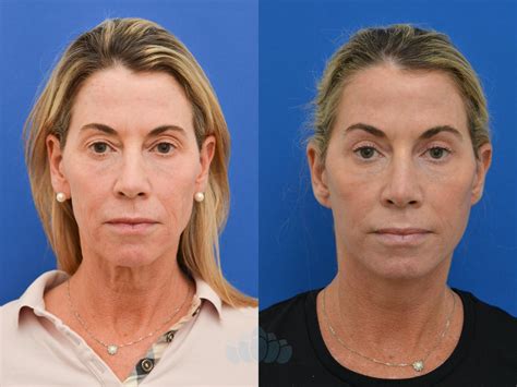 Eyelid Surgery Before And After Photo Gallery Charlotte Nc Dilworth Facial Plastic Surgery
