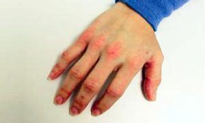 Dermatosi e rimedi omeopatici (...e non solo) | best5.it