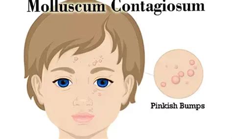 Molluscum Contagiosum Causes Symptoms Treatment 47 Off