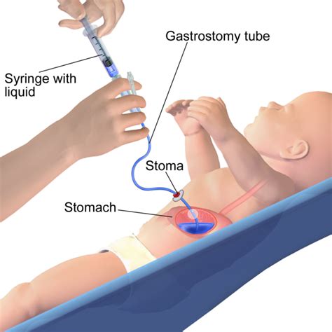 G Tubes For Newborns