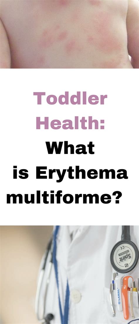 What Is Erythema Multiforme A Possible Allergic Reaction Amoxicillin