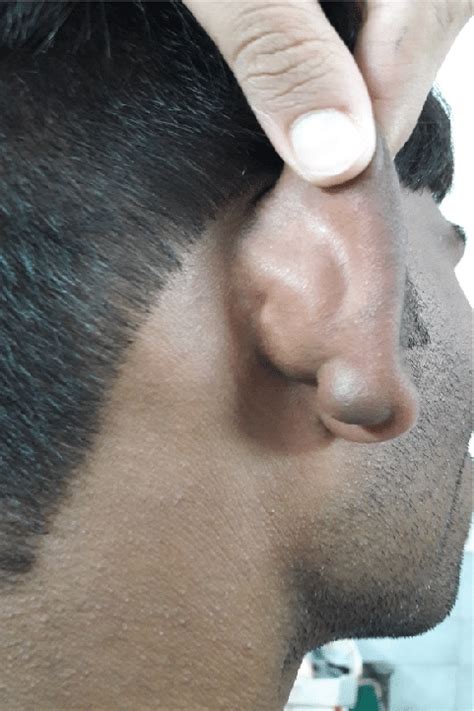 Clinical Photograph Showing The Epidermoid Cyst On The Medial Aspect Of