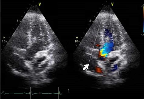 Cureus Rare Association Of Patent Foramen Ovale And Atrial Septal