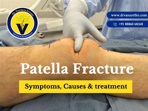 Patella Fracture Surgery Treatment Dr Vasudeva Juvvadi Vasudeva
