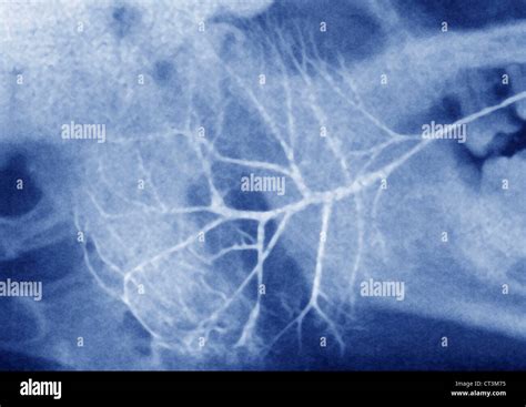 Salivary Gland Tumor X Ray Stock Photo Alamy