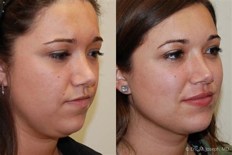 Eric M Joseph Md Chin And Neck Before And After Neck Liposuction For