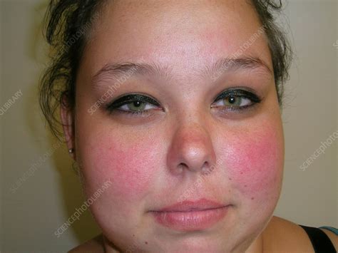 Rosacea Stock Image C0565092 Science Photo Library