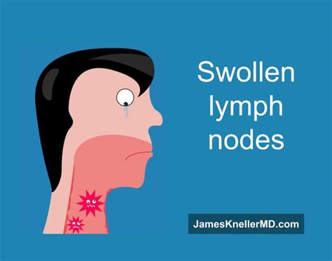 Swollen Lymph Nodes Dr James Kneller Md