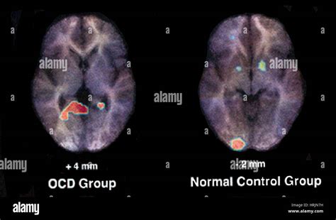 Pet Scan Normal And Ocd Brain Stock Photo Alamy