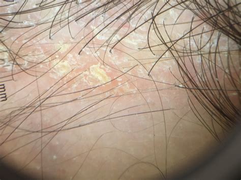 Seborrheic Dermatitis What Causes It And How Can We Treat It Donovan Hair Clinic
