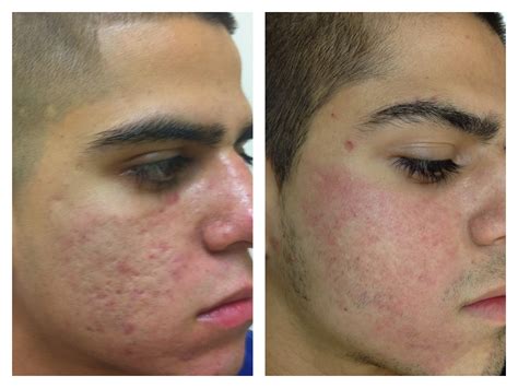 Laser Treatment For Acne Scars Before And After