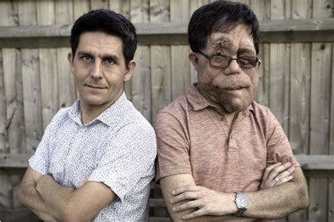 Identical Twin Brothers Neil And Adam Pearson Have Neurofibromatosis