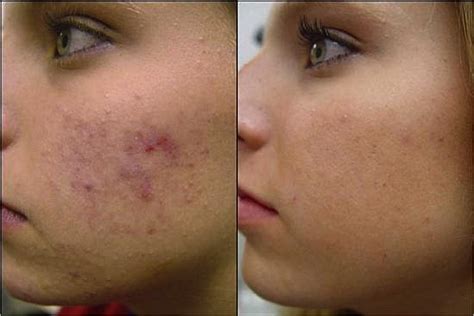 The Truth About Acne Scar Treatment Island Dermatology