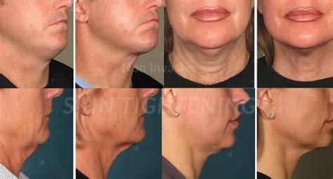 How To Get Rid Of Turkey Neck Without Surgery My Botox La Med Spa