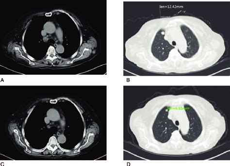 Lymph Nodes In The Mediastinum A And Metastatic Nodules In The Right