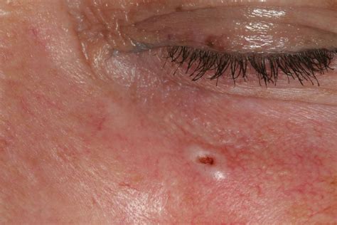 Skin Lesions Face
