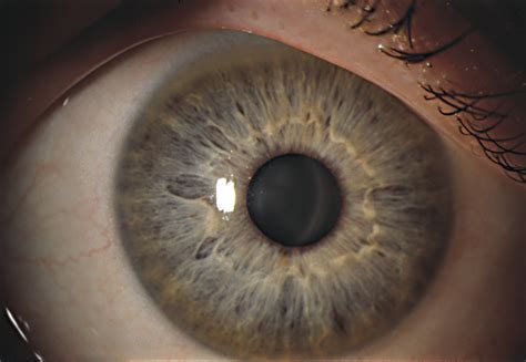 Peripheral Pigmented Corneal Ring A New Finding In Hypercarotenemia