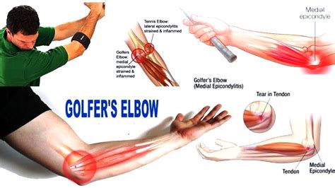 Golfers Elbow Medial Epicondylitis Causes Symptoms