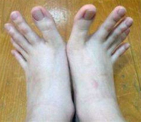 strange lady has weird toes as long as fingers